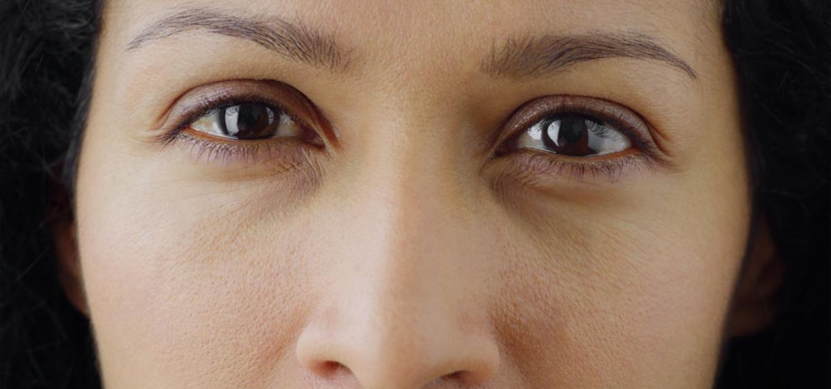 close-up of a woman with dry eye