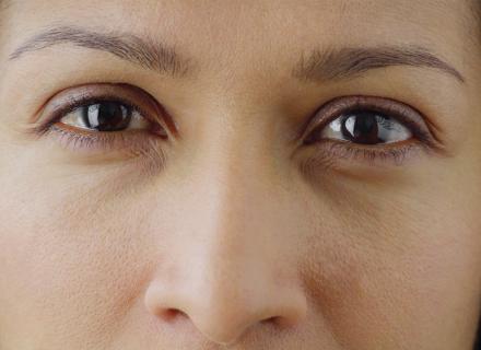 close-up of a woman with dry eye