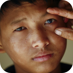 Nahaufnahme eines kleinen Jungen mit dunklem Haar, der mit ernstem Blick direkt in die Kamera schaut. Eine Hand zieht sanft die Haut unter seinem Auge nach unten und enthüllt ein trübes oder beeinträchtigtes Auge